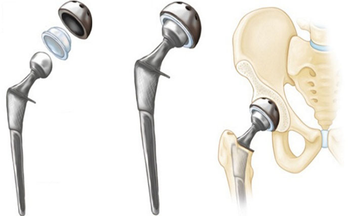 Хосе Рэймонду установлены два тазобедренных имплантата - Бодибилдинг форум AnabolicShops