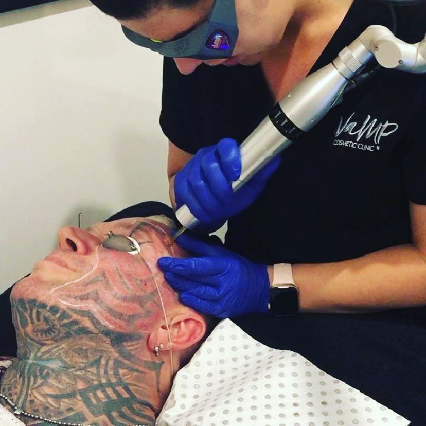 Ли Прист "сбривает" татуировку с лица самым мощным лазером в мире - Бодибилдинг форум AnabolicShops