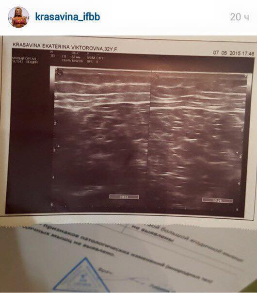 Фитнес бикини Екатерина Красавина не делала пластику ягодиц - Бодибилдинг форум AnabolicShops