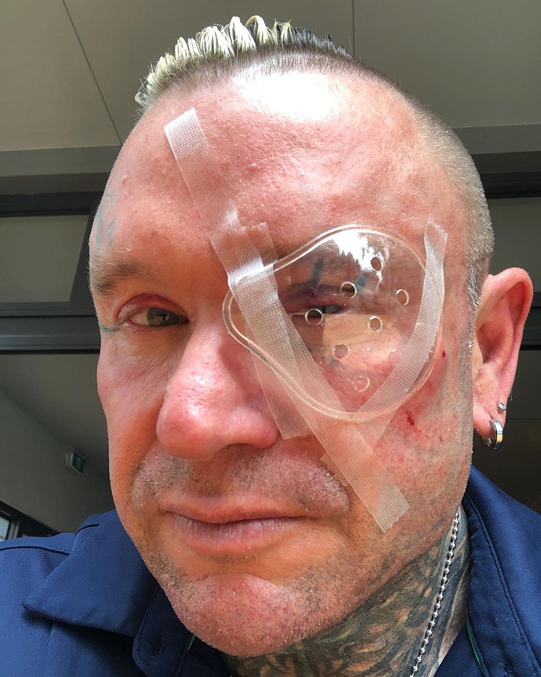 Отрезал часть глаза. Ли Прист на пути к красоте - Бодибилдинг форум AnabolicShops