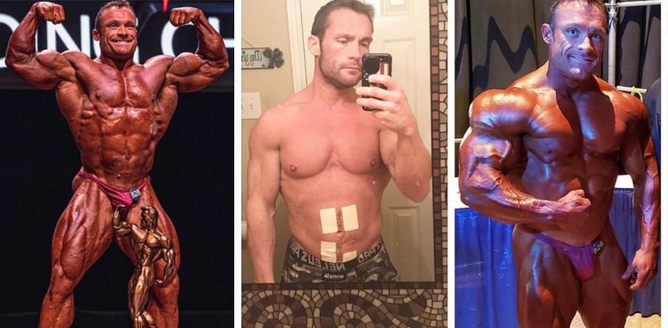 Победителю чемпионата сделали 7 хирургических операций за 3 месяца. Невероятная история - Бодибилдинг форум AnabolicShops