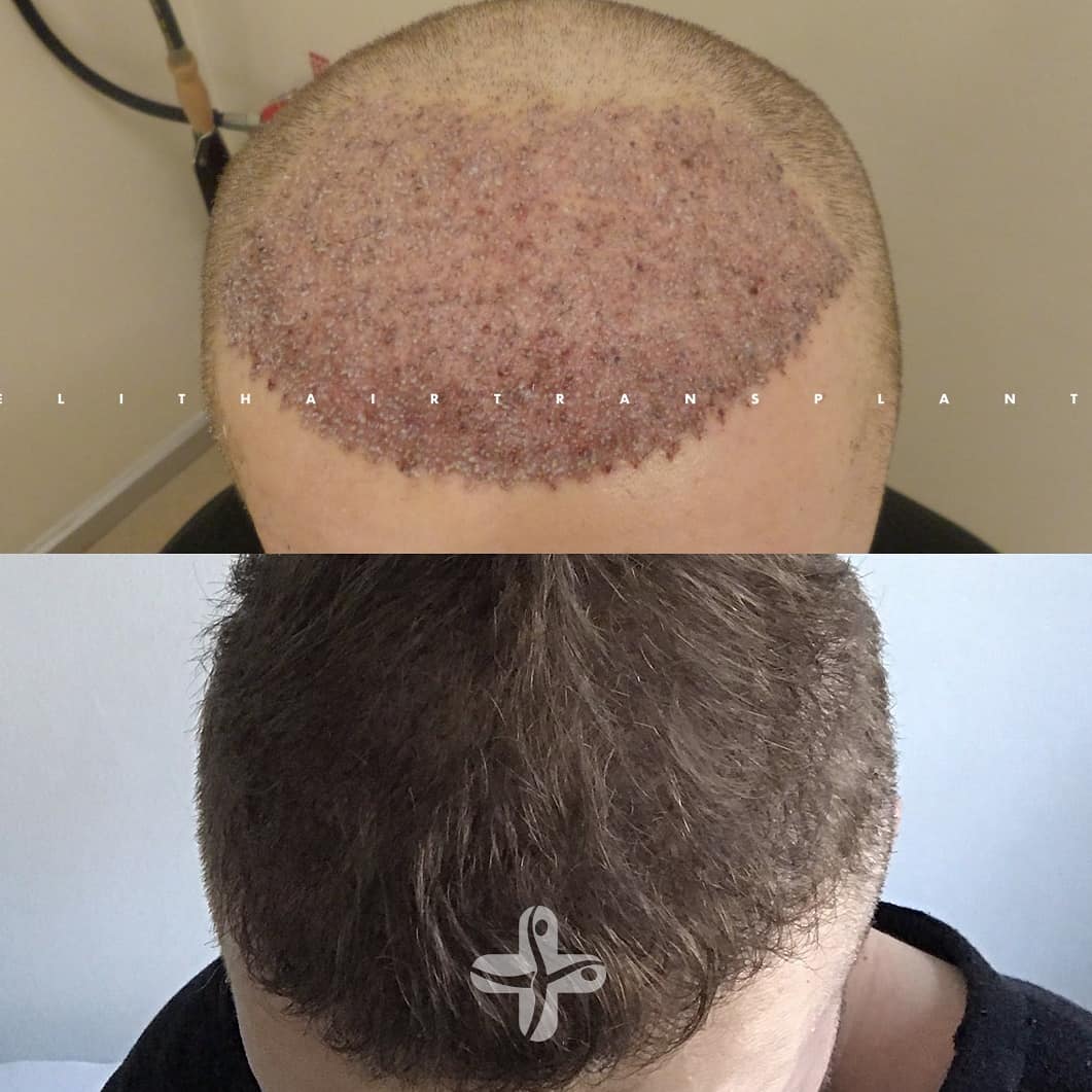 Трансплантация волос - следующий шаг в подготовке к соревнованиям? - Бодибилдинг форум AnabolicShops