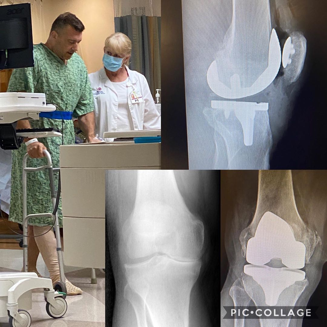 Знаменитый культурист за пару часов заменил колено - Бодибилдинг форум AnabolicShops