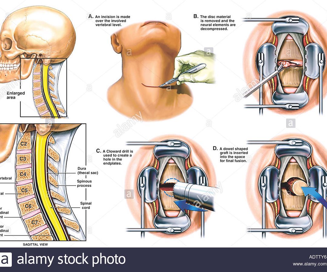 Ли Прист на операционном столе - Бодибилдинг форум AnabolicShops
