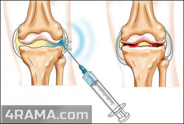 Препараты для суставов и связок - Бодибилдинг форум AnabolicShops