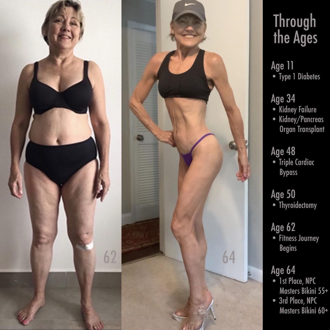 После двойной трансплантации органов на сцену турнира в 64 года - Бодибилдинг форум AnabolicShops