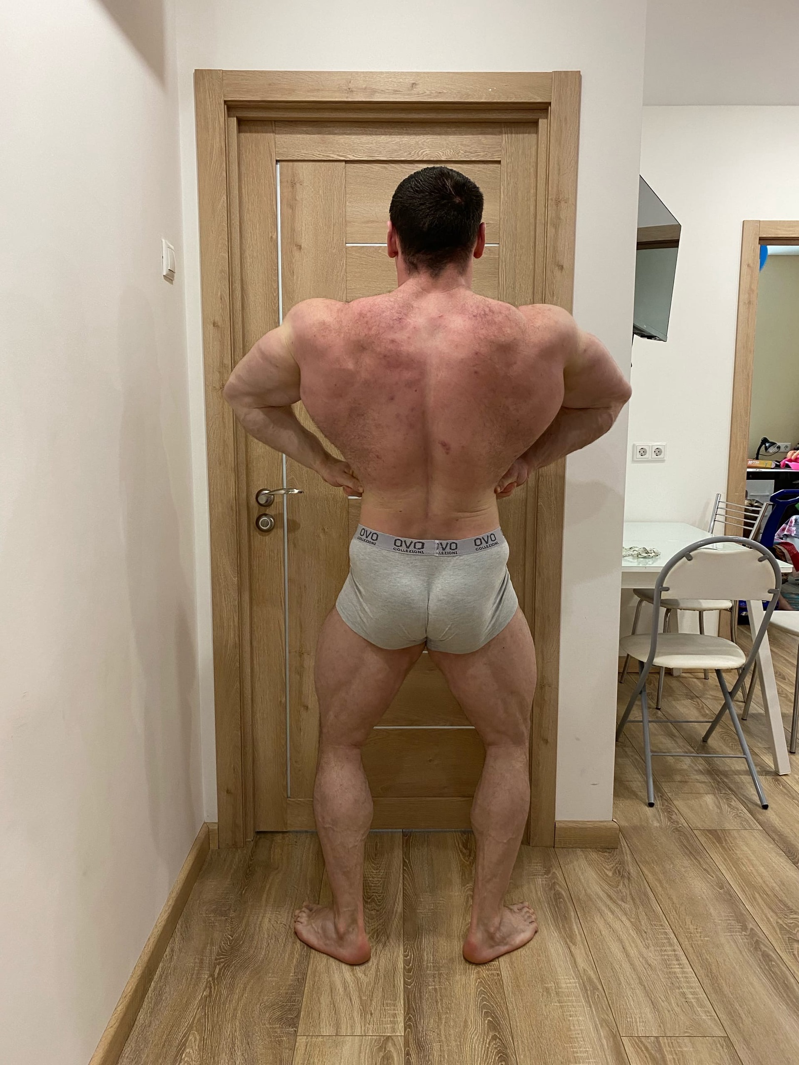 Прошло 7 недель после операции. Отчет. - Бодибилдинг форум AnabolicShops