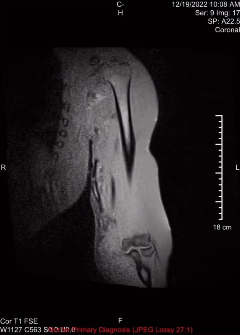 Разрыв бицепса в в мышечном брюшке - как Крис Бамстед выиграл Олимпию. Фото с рентгена - Бодибилдинг форум AnabolicShops