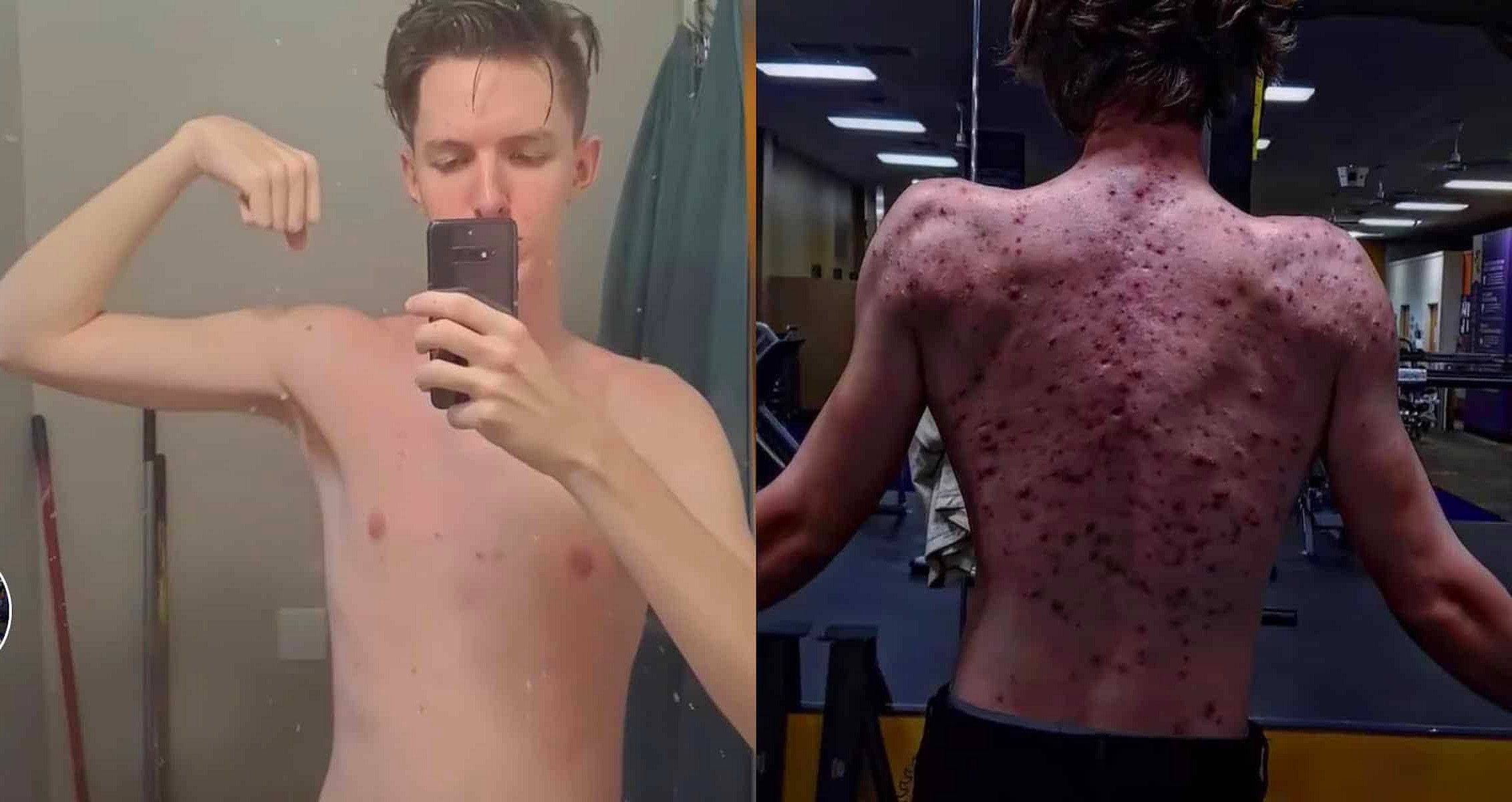 Из-за стероидов превратил спину в воспаленное месиво из прыщей, но рад продолжать - Бодибилдинг форум AnabolicShops