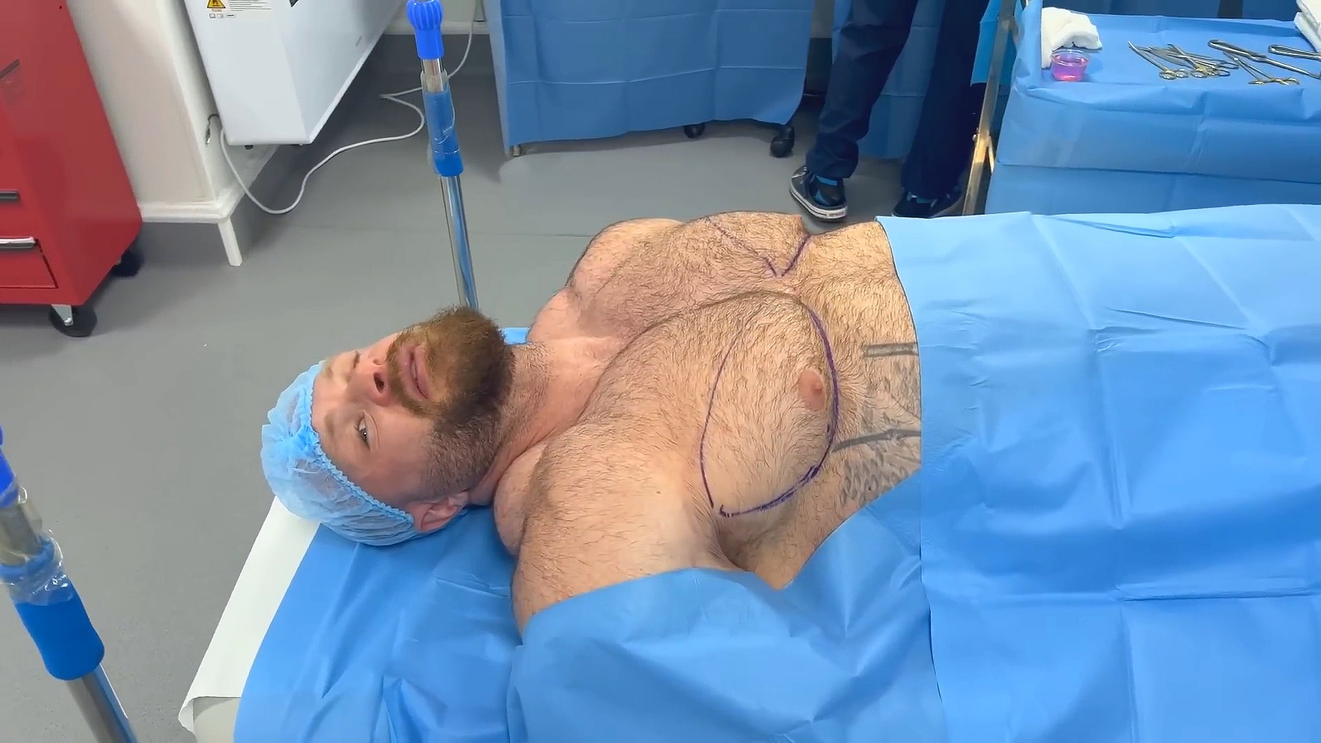 Джеймс Холлингсхед показал операцию по удалению гино на видео - Бодибилдинг форум AnabolicShops