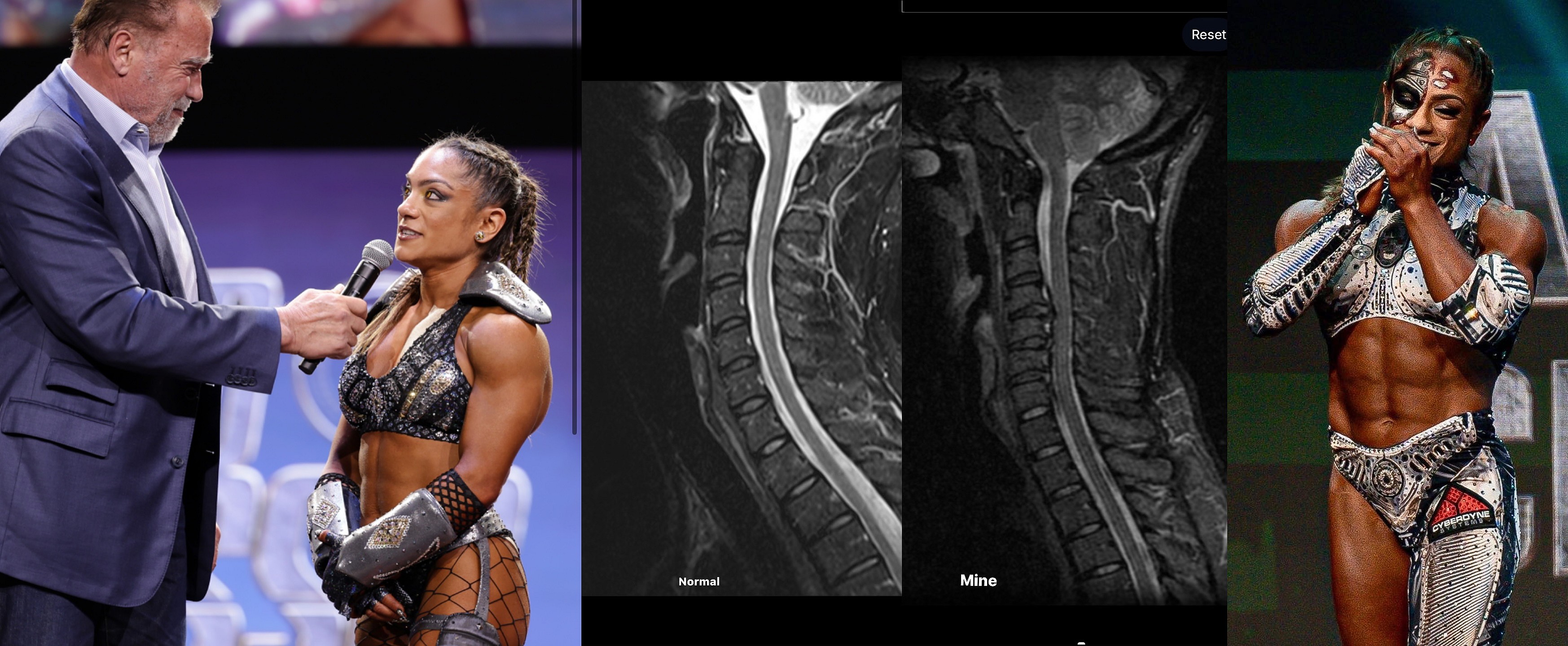 Паралич или Олимпия - врачи поставили выбор - Бодибилдинг форум AnabolicShops