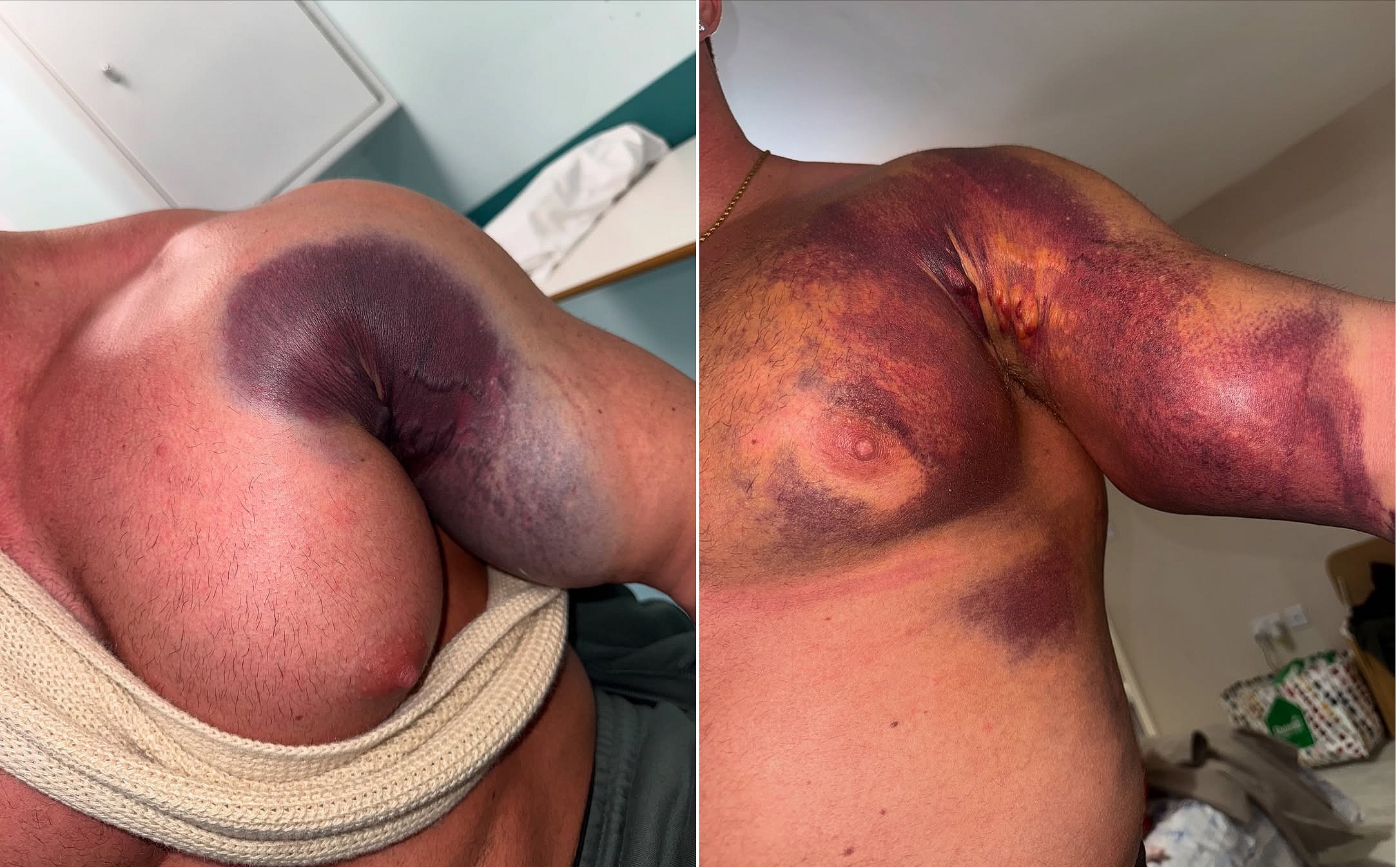 Жестокий разрыв грудной мышцы, но стероиды не бросил! - Бодибилдинг форум AnabolicShops