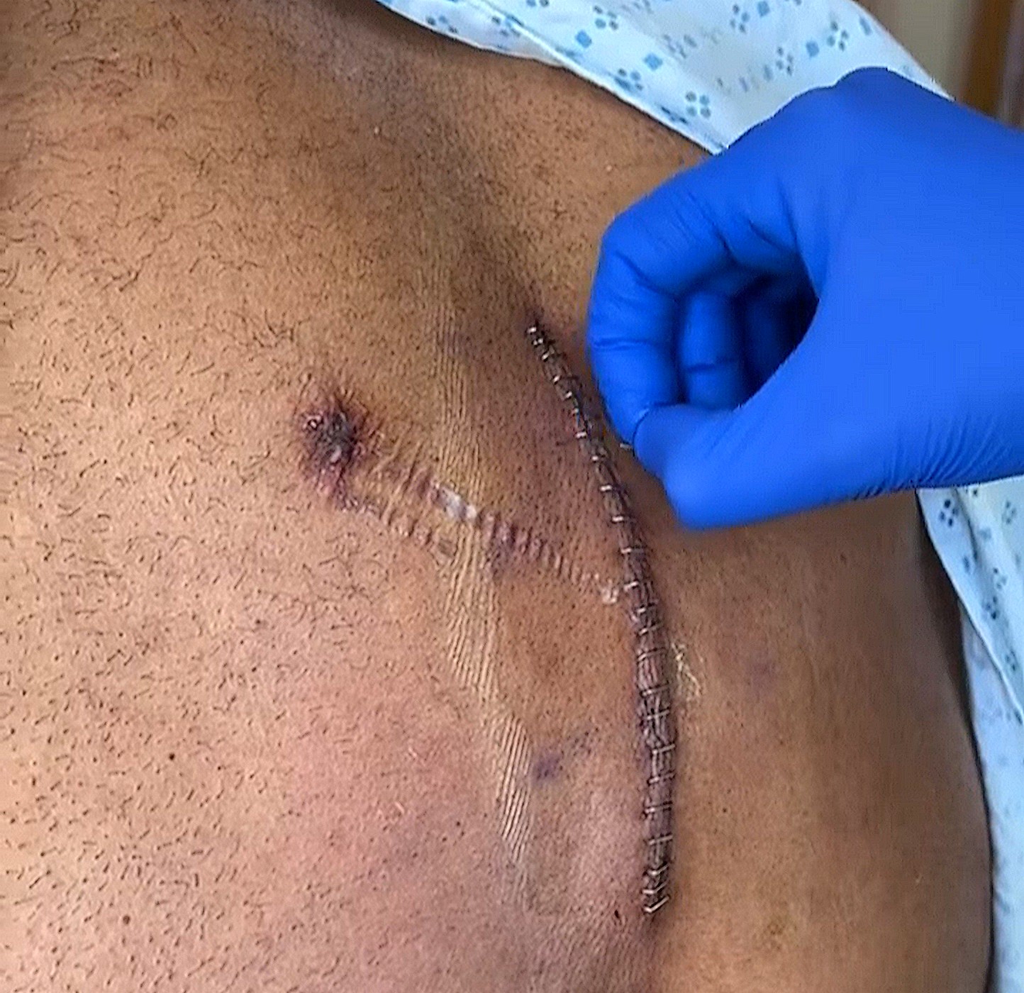 Бактерии вернулись в позвоночник Мартинеса, но не из-за стероидов - Бодибилдинг форум AnabolicShops