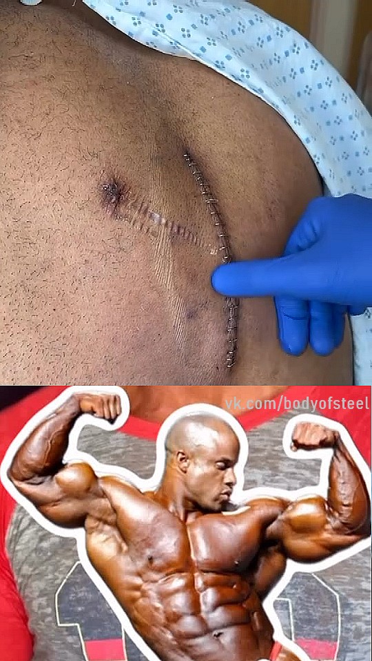 "Врачи боятся прописывать препараты" - Мартинес перенес вторую операцию из-за инфекции - Бодибилдинг форум AnabolicShops