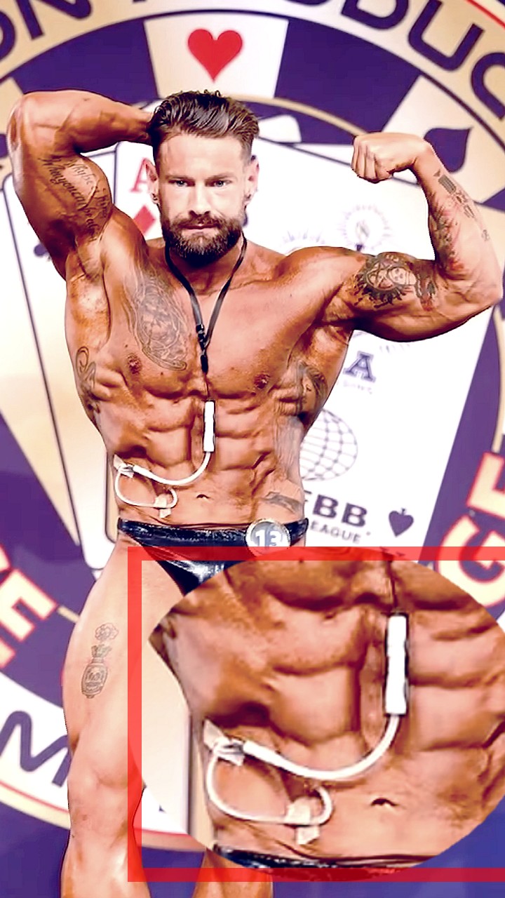 Бодибилдер с почечной недостаточностью и катетером в животе участвует уже во втором турнире - Бодибилдинг форум AnabolicShops